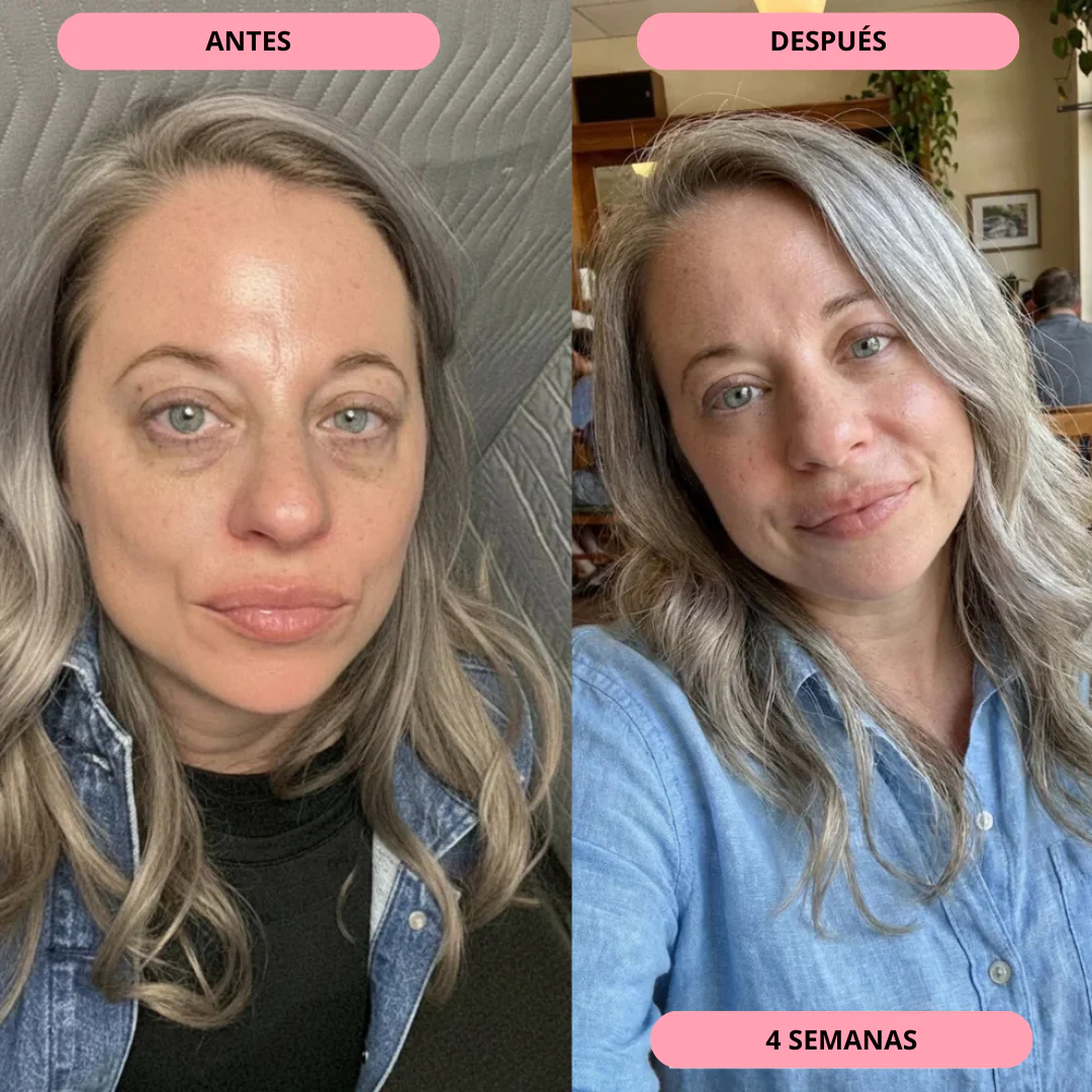 Tratamiento para bolsas y ojeras